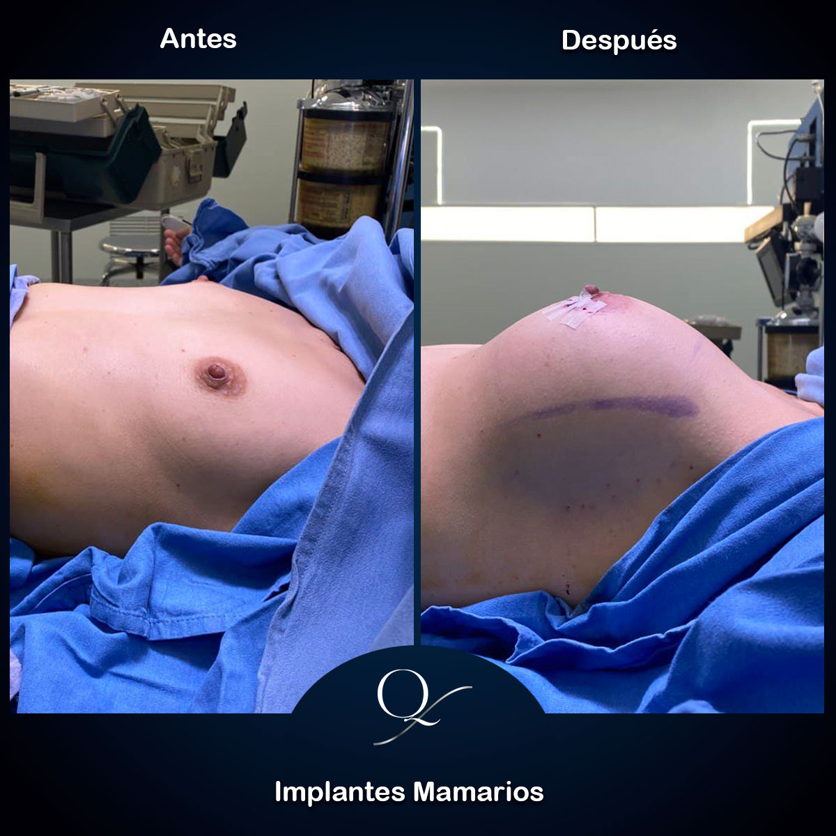 Implantes-Mamarios-Doctor-Franscisco-Quintero-004