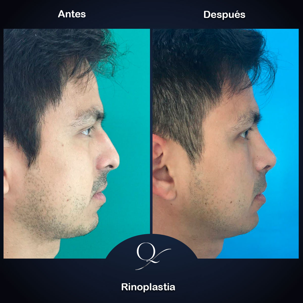 Rinoplastia-Doctor-Francisco-Quintero-006