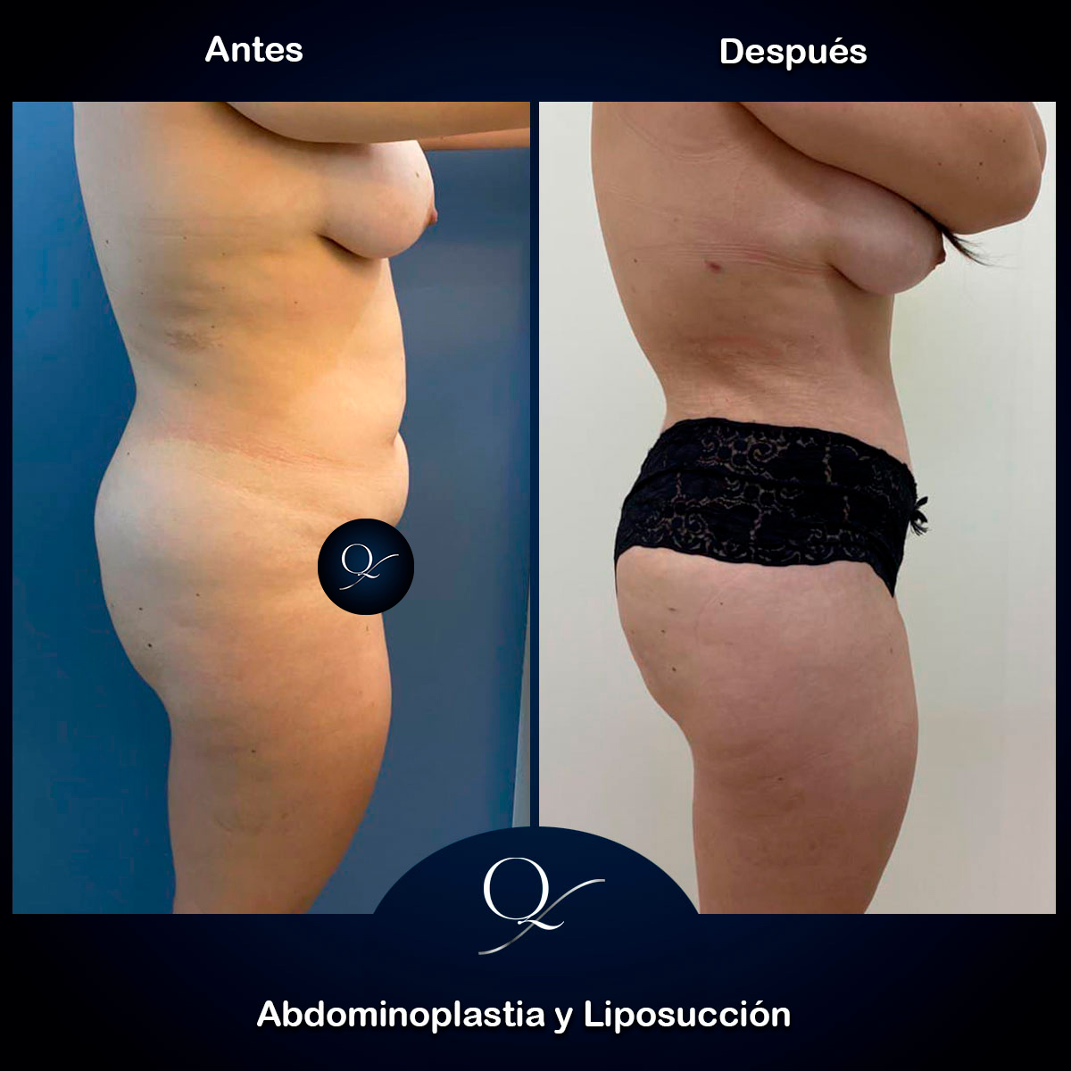 Abdominoplastia-Doctor-Francisco-Quintero-005