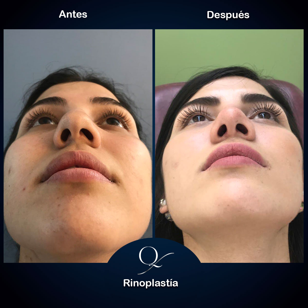 Cirugía-Plastica-Guadalajara-Rinoplastia-Doctor-Francisco-Quintero-017